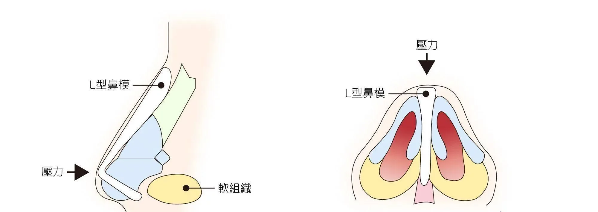 韓式隆鼻手術 | 結構式客製化打造 專屬立體自然鼻形 | 恆美學