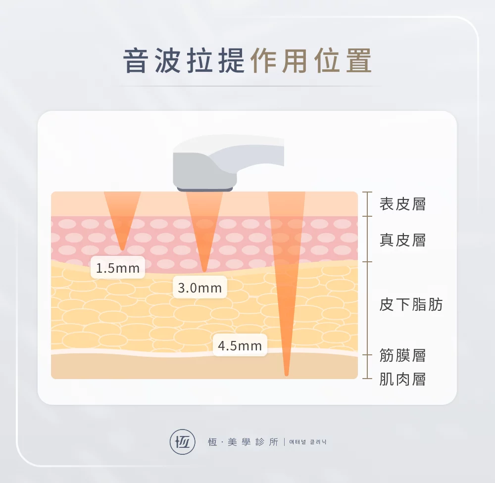 音波拉提作用位置