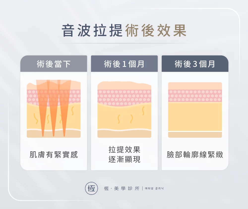 音波拉提術後效果