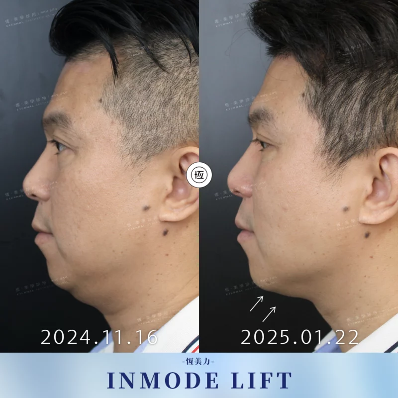 Inmode BA20250411 1