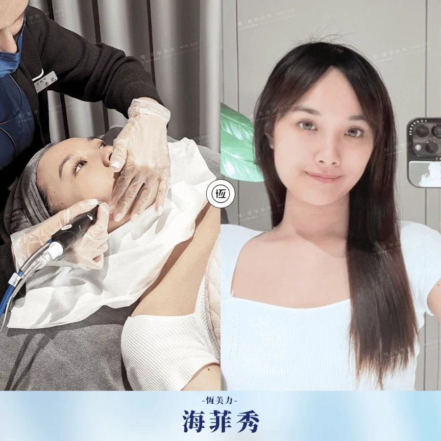 HydraFacial 海菲秀 Syndeo