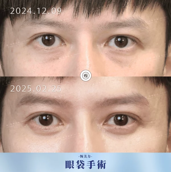 眼袋20250411 1 1