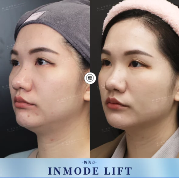 Inmode Ba 20250602 1
