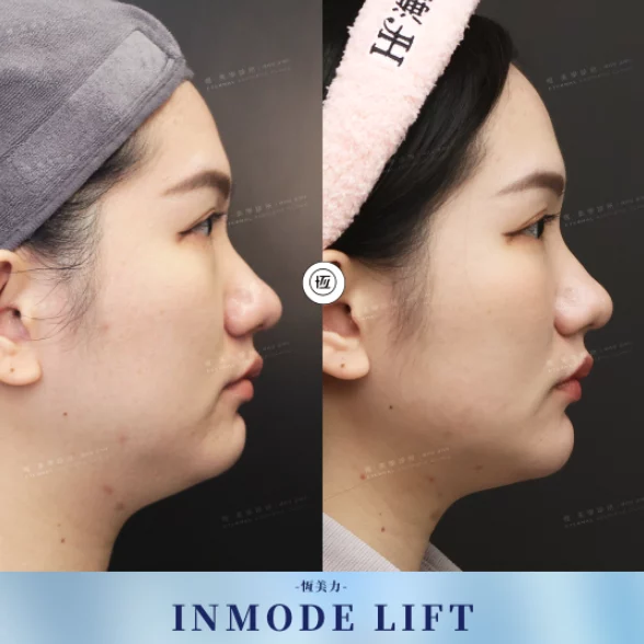 Inmode Ba 20250602