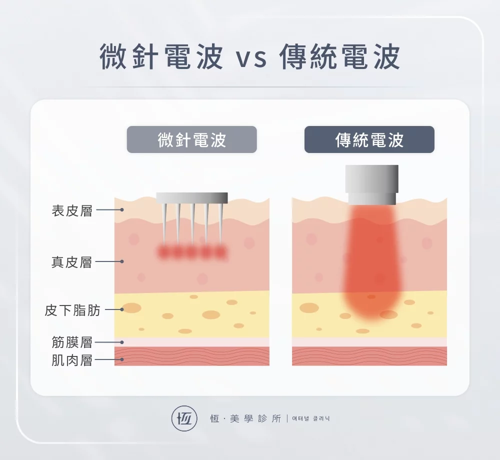 微針電波選哪種?無限/矽谷/墨菲斯電波效果、修復期一次看 - 恆美學診所