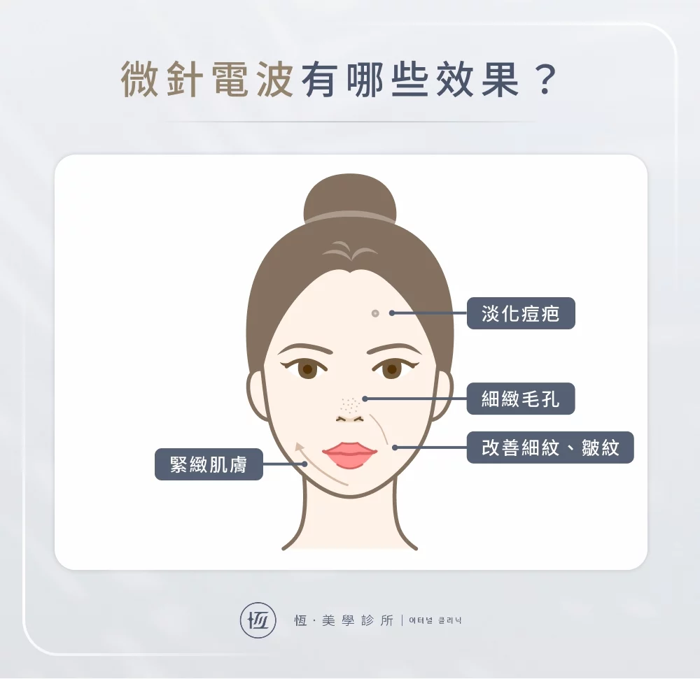 微針電波有什麼效果？
