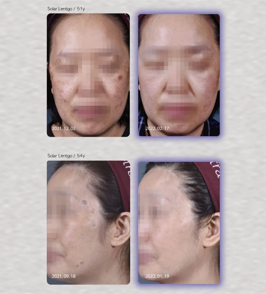 Reepot Ai 時光雷射 | BA照片 | 治療流程 | 恆美學