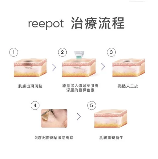 Reepot Ai 時光雷射 | 療程步驟 | 治療流程 | 恆美學