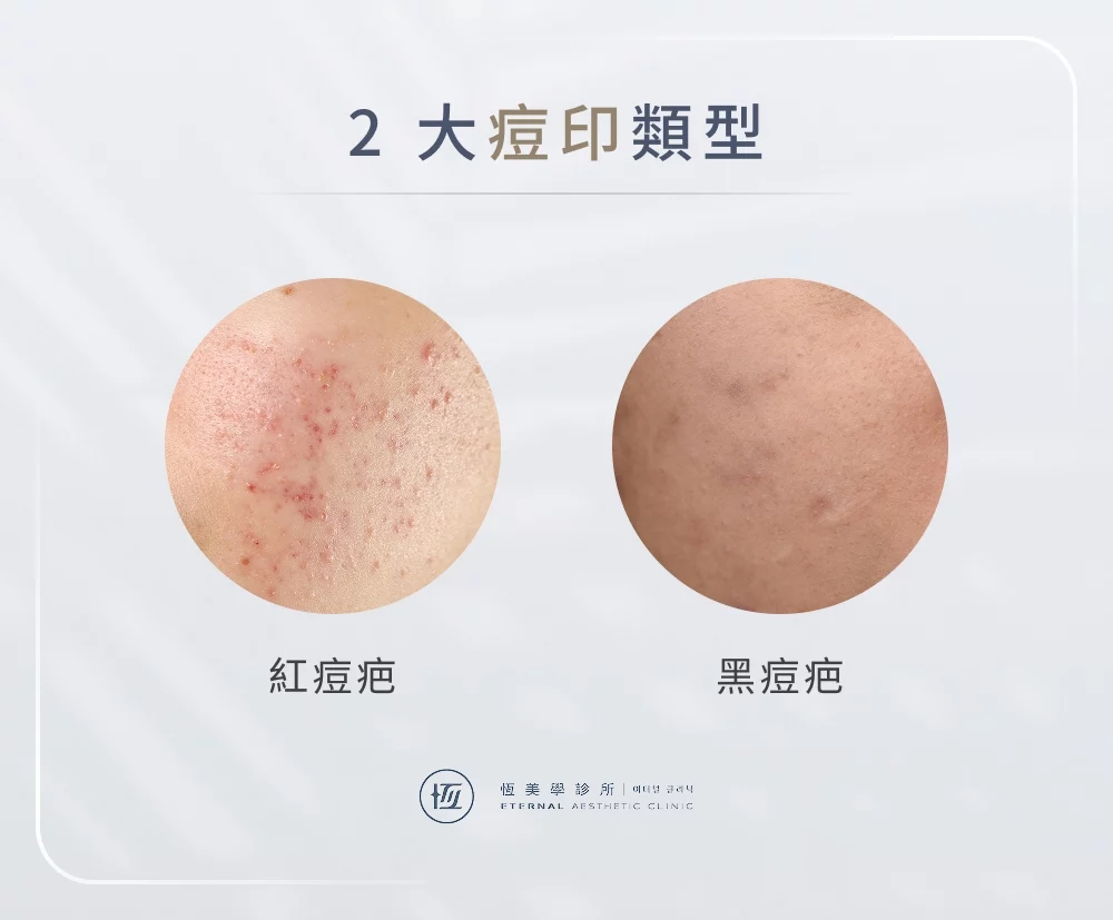 2 大痘印類型