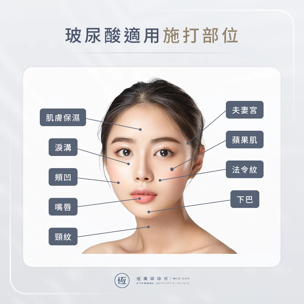 玻尿酸可以打哪裡？