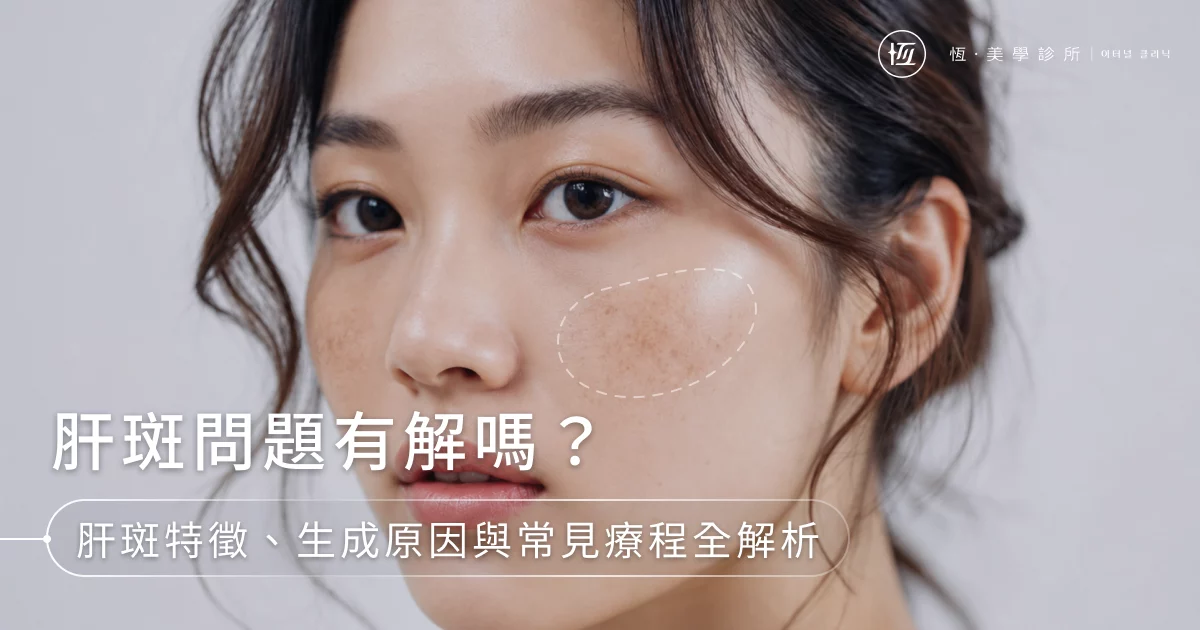 肝斑問題有解嗎？肝斑特徵、生成原因與常見療程全解析