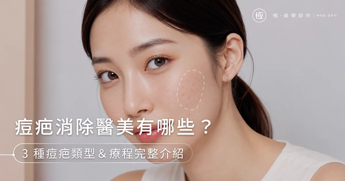 痘疤消除醫美有哪些？3種痘疤類型＆5大適用療程完整介紹