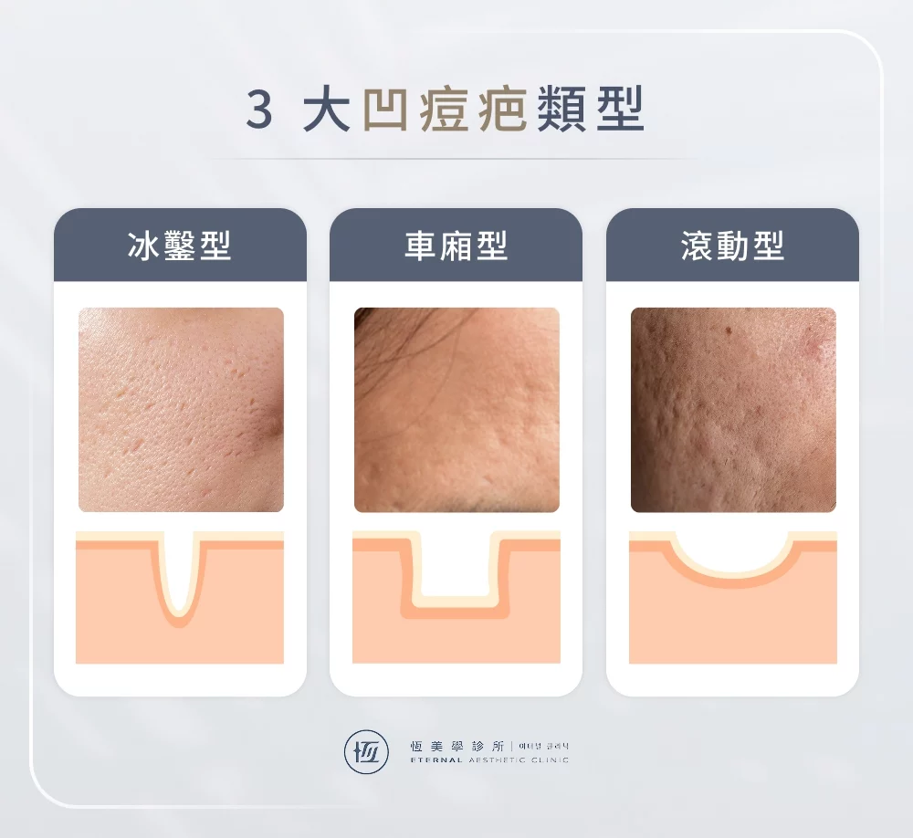 3 大凹痘疤類型