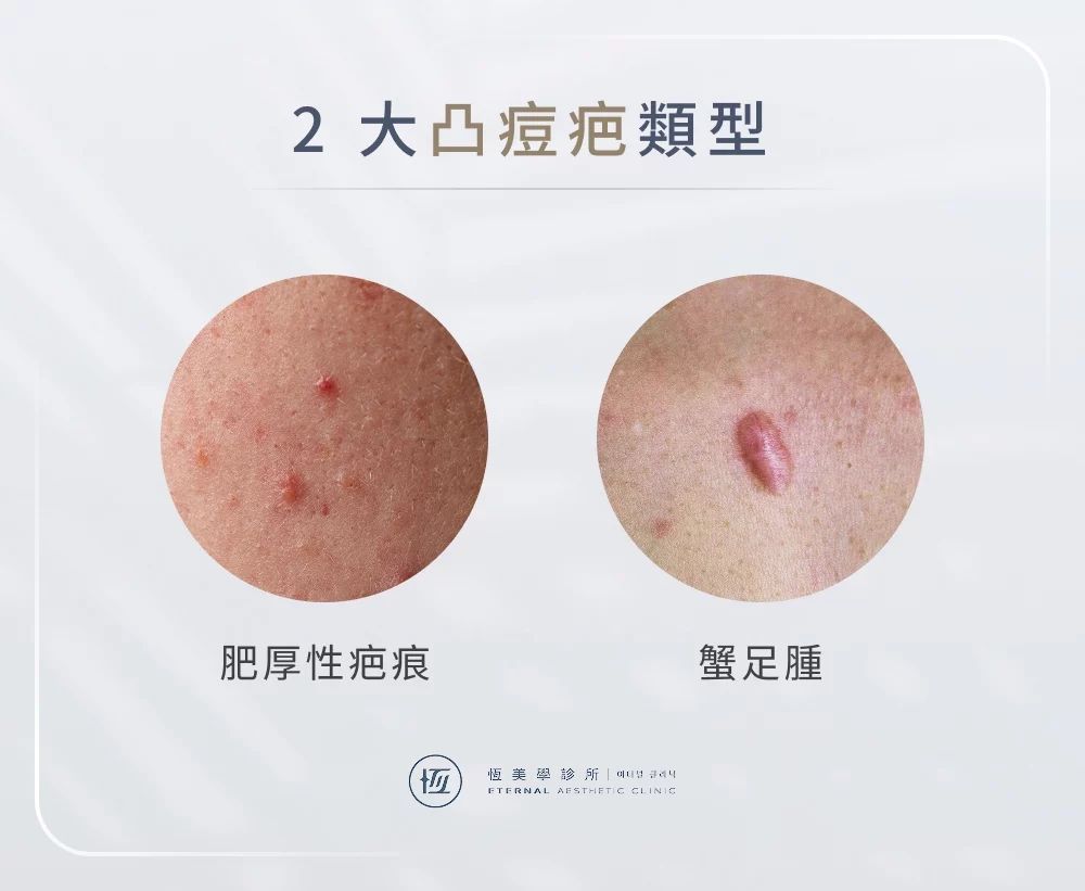 2 大凸痘疤類型