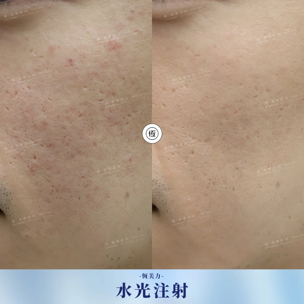 水光注射