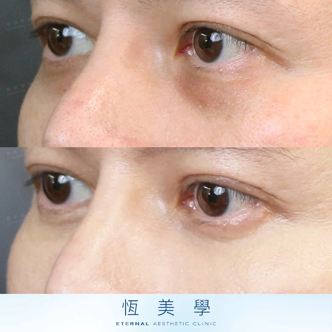BA 眼袋 20260917